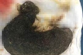 Khối u tóc được lấy ra trong cơ thể của bệnh nhân. (Ảnh: PV/Vietnam+)