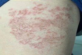 Bệnh nhân mắc ấu trùng giun đũa chó. (Ảnh: PV/Vietnam+)