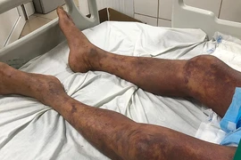 Một trường hợp toàn thân tím đen vì mắc liên cầu lợn. (Ảnh: PV/Vietnam+)