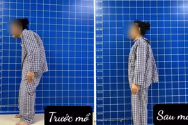 Bệnh nhân trước và sau phẫu thuật. (Ảnh: PV/Vietnam+)