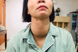 Khối u "khổng lồ" trên cổ bệnh nhân. (Ảnh: PV/Vietnam+)