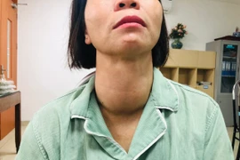 Khối u "khổng lồ" trên cổ bệnh nhân. (Ảnh: PV/Vietnam+)