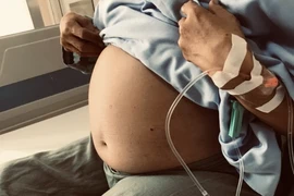 Khối u trong bụng của bệnh nhân trước khi phẫu thuật. (Ảnh: PV/Vietnam+)