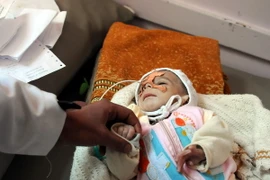 Điều trị cho trẻ em bị suy dinh dưỡng tại bệnh viện ở Sanaa, Yemen ngày 15/1. (Nguồn: THX/TTXVN)