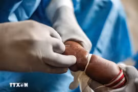 Nhân viên y tế điều trị cho em nhỏ mắc đậu mùa khỉ tại Nyiragongo, Cộng hòa Dân chủ Congo ngày 15/8/2024. (Ảnh: THX/TTXVN)