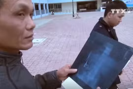 [Video] Bác sỹ để quên kéo trong bụng bệnh nhân suốt 18 năm