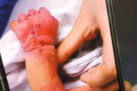 Đau lòng cảnh người mẹ tâm thần cắn nát tay con trai vừa sinh