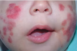 Mắc bệnh hiếm chưa từng ghi nhận ở Việt Nam, bé trai được cứu kịp thời