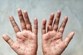 Israel chuẩn bị triển khai tiêm vaccine ngừa đậu mùa khỉ 