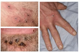 Mỹ và châu Âu đẩy mạnh cuộc chiến chống bệnh đậu mùa khỉ