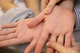 Thông thường, bệnh nhân bị số xuất huyết sẽ xuất hiện triệu chứng lâm sàng đỏ lòng bàn chân, bàn tay, sau đó xuất hiện các nốt ban dưới da. (Ảnh: Minh Quyết/TTXVN)