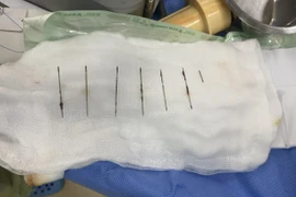 7 cây kim được các bác sỹ phẫu thuật gắp ra khỏi lồng ngực bệnh nhân. (Ảnh: TTXVN phát)