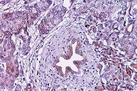 Lớp cắt biểu bì ung thư tuyến tụy. (Nguồn: eurekalert.org)