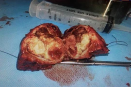 U gan của cháu bé 11 tháng tuổi bị ung thư nguyên bào gan được cắt thành công. (Ảnh: TTXVN phát)