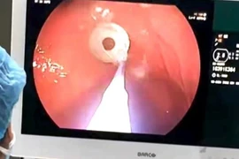 Hình ảnh nội soi lấy dị vật ra khỏi dạ dày bệnh nhi. (Ảnh: TTXVN phát)
