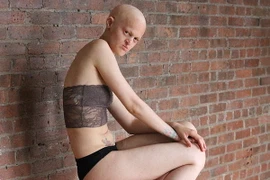 Người mẫu bị dị tật bẩm sinh cởi đồ nhằm phản đối kỳ thị