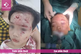Phú Thọ: Bé gái 3 tuổi bị thương nặng do chó nhà hàng xóm cắn