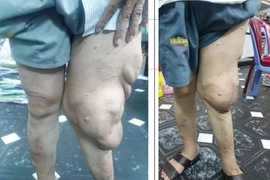 Một bệnh nhân dị dạng “chân voi” trước và sau phẫu thuật. (Nguồn: TTXVN)