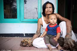 'Người cây' Dede Koswara. (Nguồn: Dailymail)