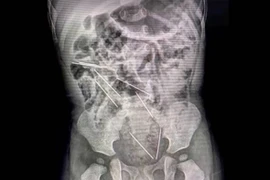 Peru: Gắp ra 8 kim tiêm nằm rải rác trong bụng bé trai 2 tuổi