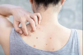 Mụn lưng là vấn đề nhiều người gặp phải. (Ảnh: iStock)