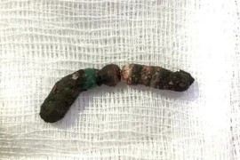 Chuỗi 7 viên bi nam châm được lấy ra từ bụng bé gái. (Nguồn: suckhoedoisong.vn)