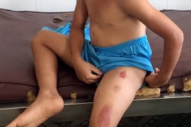 Cháu H với nhiều vết thương trên người. (Ảnh: TTXVN phát)