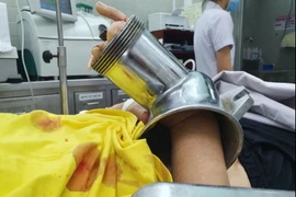 Toàn bộ bàn tay phải của người bệnh nằm gọn trong cối máy xay thịt. (Nguồn: TTXVN phát)