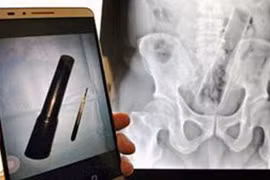 Vật thể lạ có dạng như chiếc micro mắc kẹt trong người anh Cai. (Nguồn: Daily Mail)