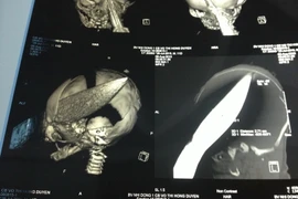 Hình ảnh chụp X-quang. (Ảnh do bệnh viện cung cấp)