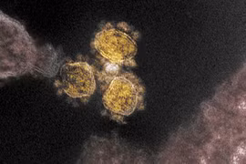 Hình ảnh quét qua kính hiển vi điện tử cho thấy virus SARS-COV-2 trên mẫu bệnh phẩm của bệnh nhân COVID-19. (Ảnh: AFP/TTXVN) 