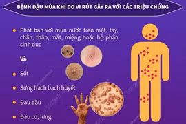 Khuyến cáo phòng chống đậu mùa khỉ với hành khách nhập cảnh Việt Nam