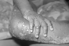 Một em nhỏ mắc bệnh đậu mùa khỉ. (Ảnh: Getty Images/TTXVN) 