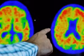 Hình ảnh não của bệnh nhân Alzheimer khi chụp PET. (Nguồn: Reuters)