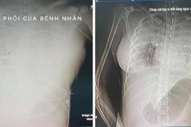 Hình chụp CT có thuốc cản quang cho thấy có nhiều ổ xuất huyết lớn. (Nguồn: vov.vn)