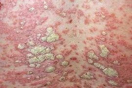 Biểu hiện của bệnh vẩy nến. (Nguồn: Internet)