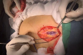 Các bác sỹ thực hiện phẫu thuật cho bệnh nhi. (Ảnh: TTXVN phát)