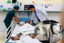 Bé trai 9 tuổi bị vỡ đại tràng do dùng máy bơm hơi vào hậu môn