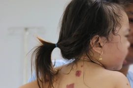 Các vết lở loét trên cơ thể bệnh nhi. (Ảnh: TTXVN phát)