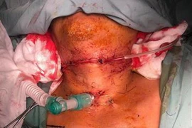  Hình ảnh khí quản và thực quản đã được tái thông sau phẫu thuật. (Ảnh: TTXVN)