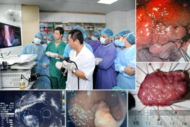 Cắt tách niêm mạc qua nội soi cho bệnh nhân có khối u lớn ở dạ dày