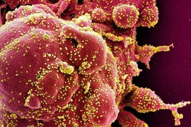 Hình ảnh quét qua kính hiển vi điện tử cho thấy một tế bào (màu đỏ) bị virus SARS-COV-2 (màu vàng) xâm nhập, lấy từ mẫu bệnh phẩm của bệnh nhân COVID-19. (Ảnh: AFP/ TTXVN)