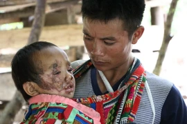 Cháu Cà Văn Hảo, 4 tuổi, ở bản Huổi Liếng (Mường La) bị đá đè vào người làm tổn thương vùng mặt và gãy chân phải. (Ảnh: Nguyễn Cường/TTXVN)