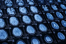 Phát hiện sớm chứng tự kỷ ở trẻ nhờ phương pháp chụp cắt lớp não