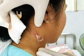 Vết áp xe trên cổ của bệnh nhân đang được tiếp tục theo dõi, điều trị. (Ảnh: TTXVN phát)