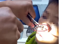 Con vắt sống khoảng 10 ngày trong mũi của bệnh nhân. (Ảnh: Bệnh viên Đa khoa tỉnh Kon Tum)