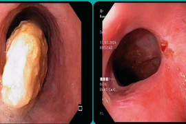 Khối dị vật chiếm gần hết lòng thực quản và lòng thực quản sau khi dị vật đã được lấy ra. (Ảnh: TTXVN phát)