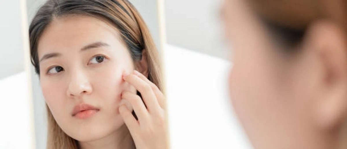 Bí quyết chăm sóc da mụn ẩn tại nhà để lấy lại vẻ ngoài mịn màng