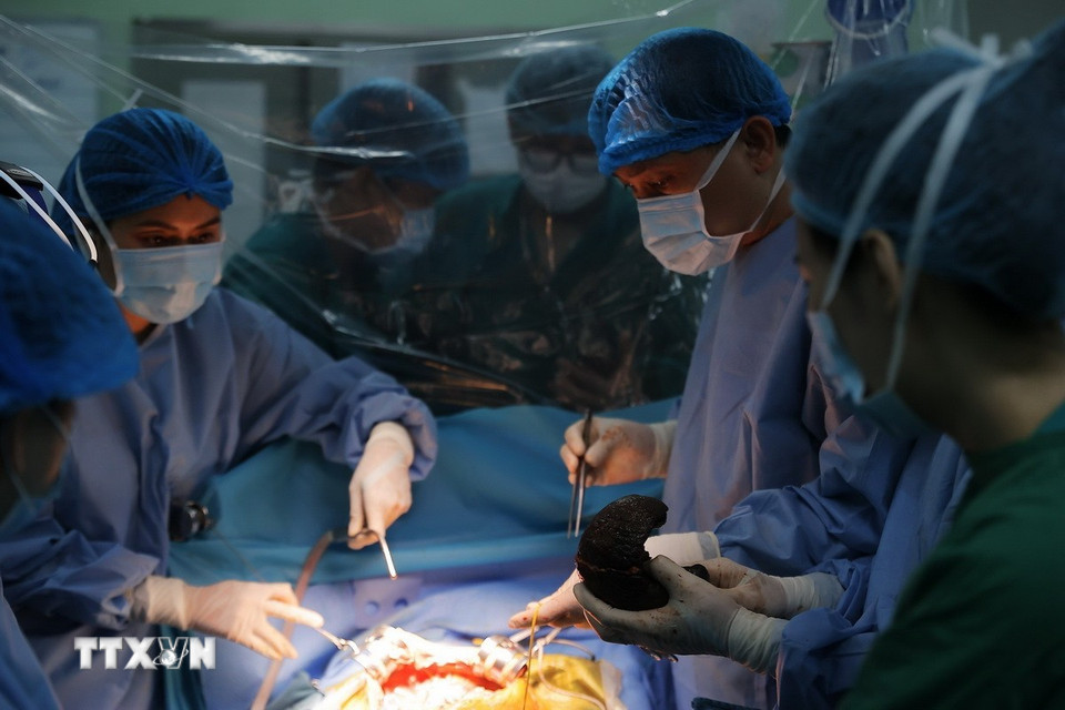 Bác lý lấy phần gan hỏng từ bệnh nhi, chuẩn bị tiến hành ghép gan mới cho bệnh nhi. (Ảnh: Minh Quyết/TTXVN)