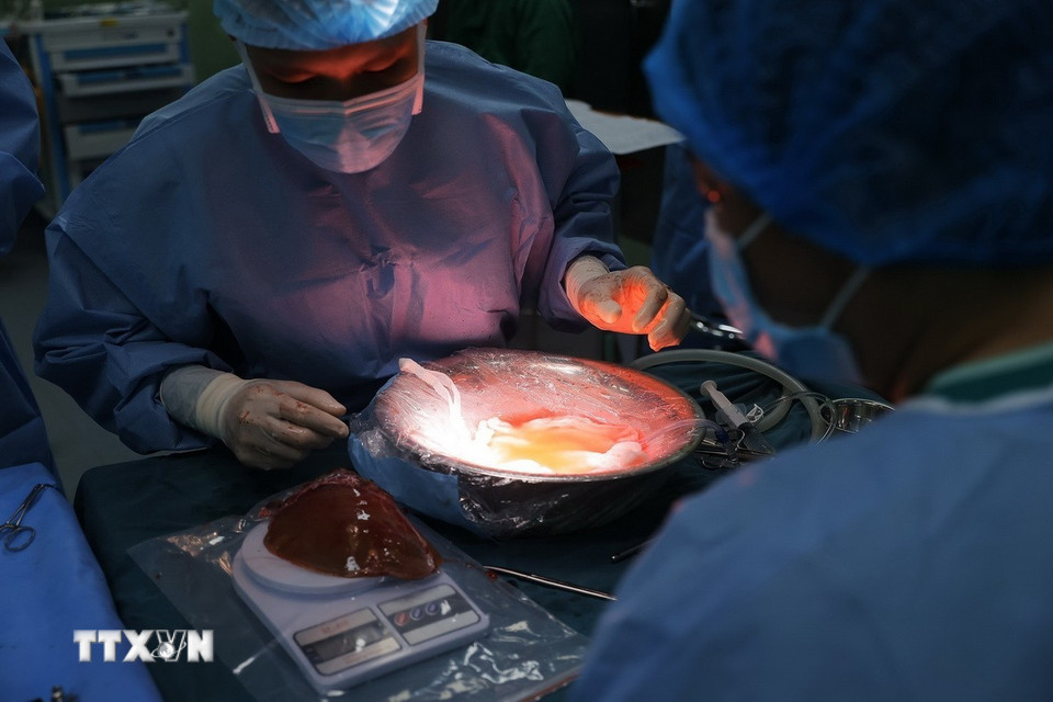 Các thông số của gan được kiểm tra kỹ trước khi chuyển ghép cho bệnh nhi. (Ảnh: Minh Quyết/TTXVN)